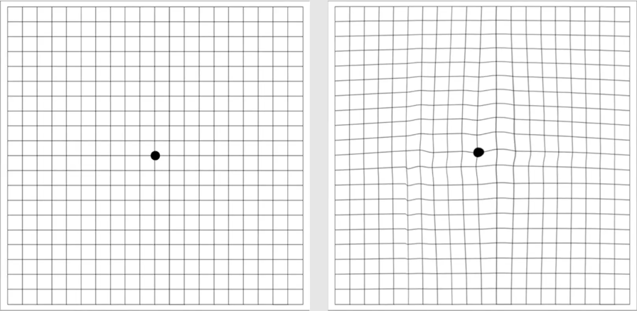 Amsler Grid