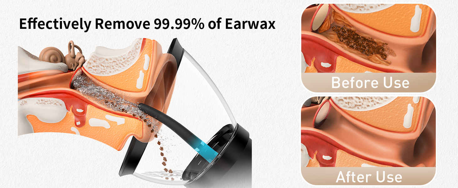 earwax removal kit