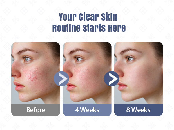 Your clear skin Routine Starts Here
