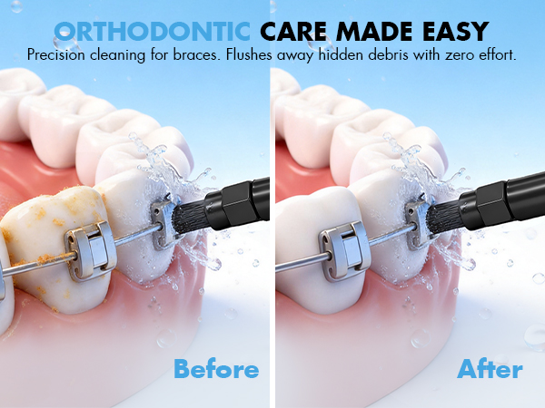 water flosser for braces
