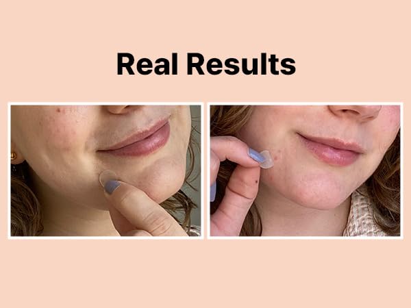 real results suck gunk out pimples whiteheads fast healing adhesive leave on overnight reduce size