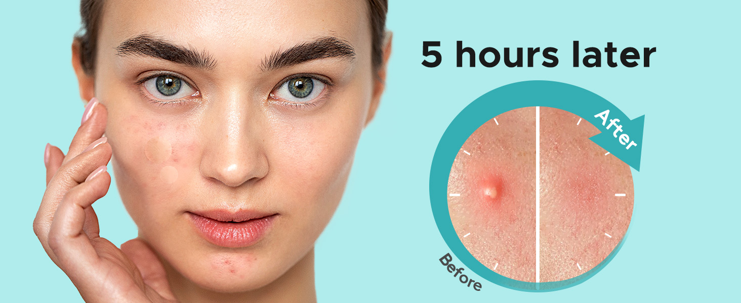 pimple patches for face