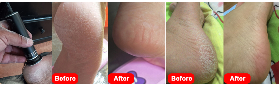 electric callus remover for feet