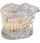 Ultrassist Transparent Disease Teeth Model with Dental Implant Bridge, Dental Model for Patient a...