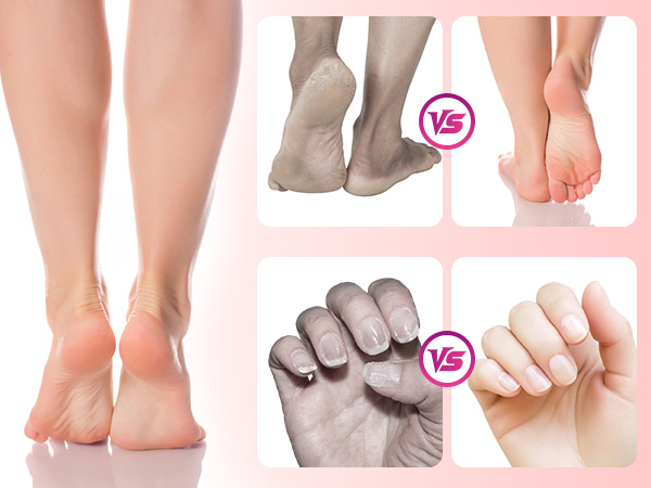 electric foot callus remover