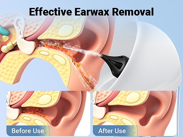 Earwax Removal, Ear Cleaner