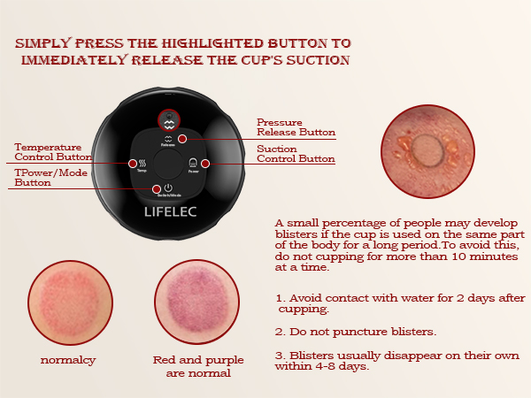 cupping set