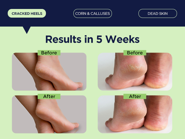 cracked heels