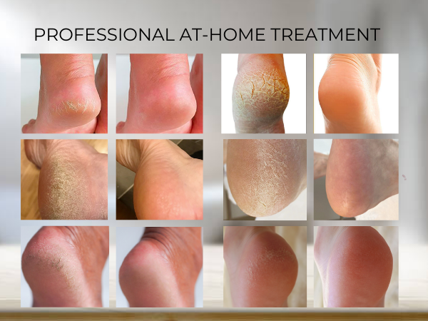 WONDER PEDI PREMIUM CALLUS REMOVER, foot file dead skin remover for feet