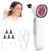 ScopeAround Otoscope with Light, 720P HD Ear Cleaning Camera & 6 LED Lights Ear Scope, 1.45" IPS ...