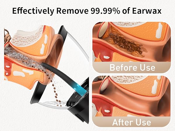 ear wax removal tool