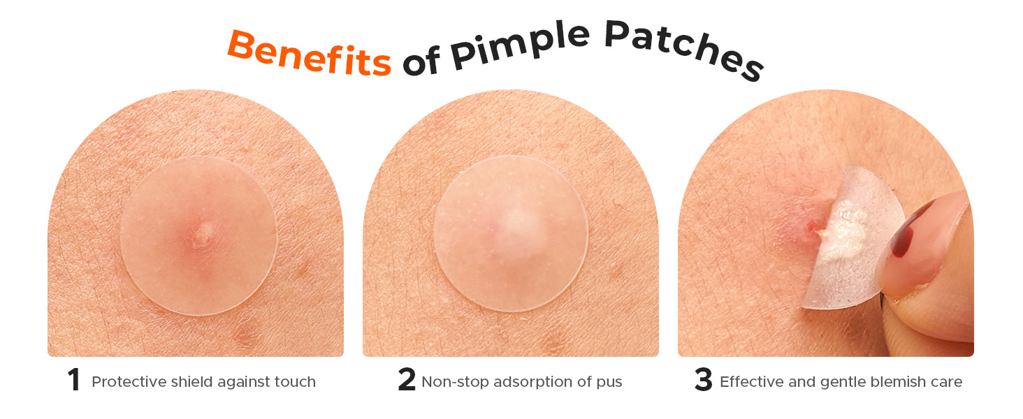 Benefits of Pimple Patches