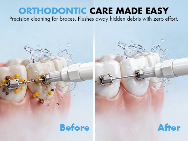 water flosser for braces