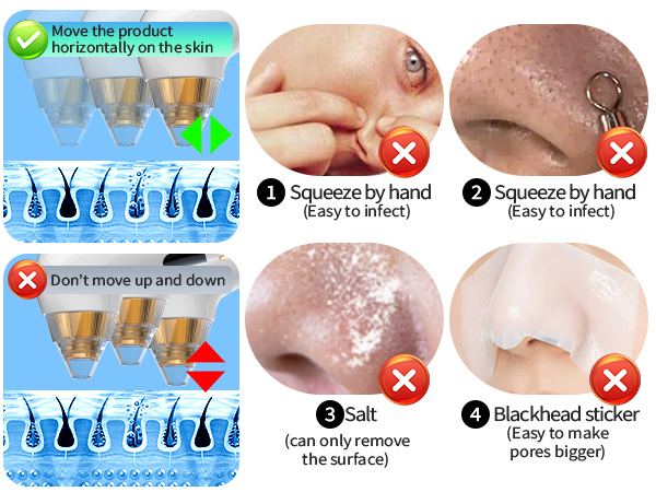 Blackhead remover