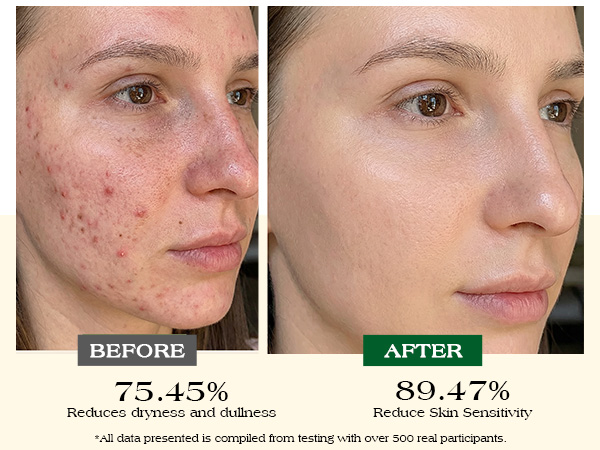 89.47% Reduce Skin Sensitivity 75.45% Reduces dryness and dullness