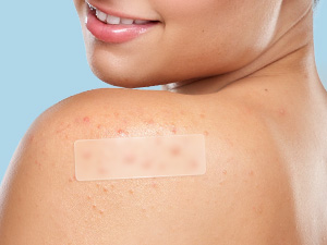 Large Pimple Patches for Face