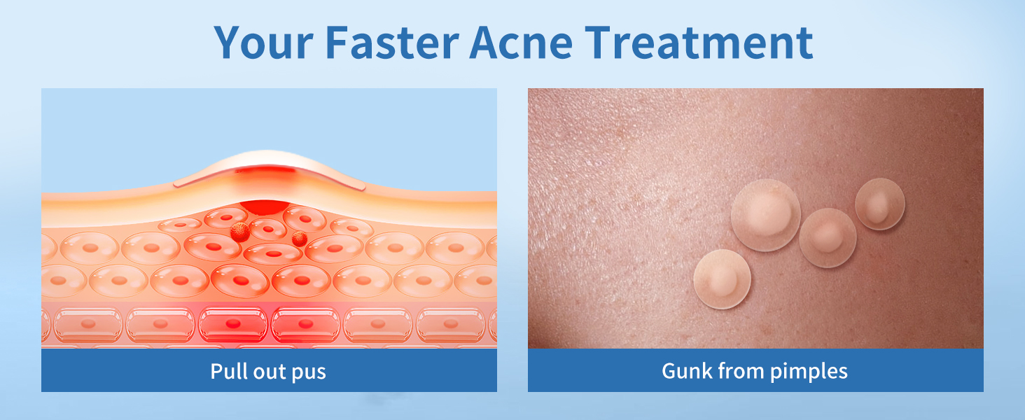 pimple patches for face