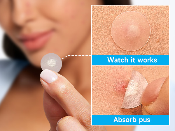 pimple patches