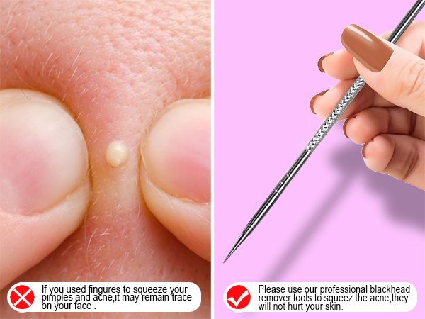BLACKHEADS EXTRACTOR TOOLS