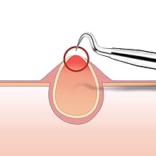 blackhead remover