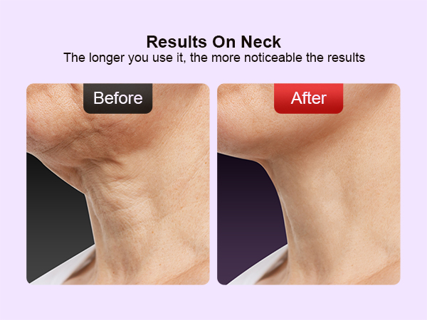 face lift device