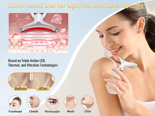 face lift device