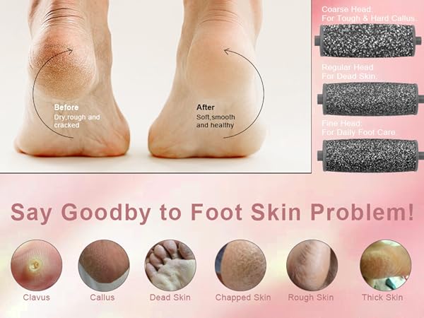 callus remover for feet electric