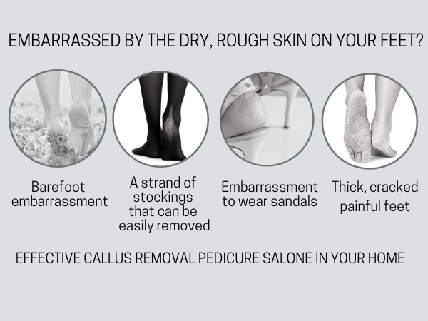 EMBARRASSED BY THE DRY, ROUGH SKIN ON YOUR FEET