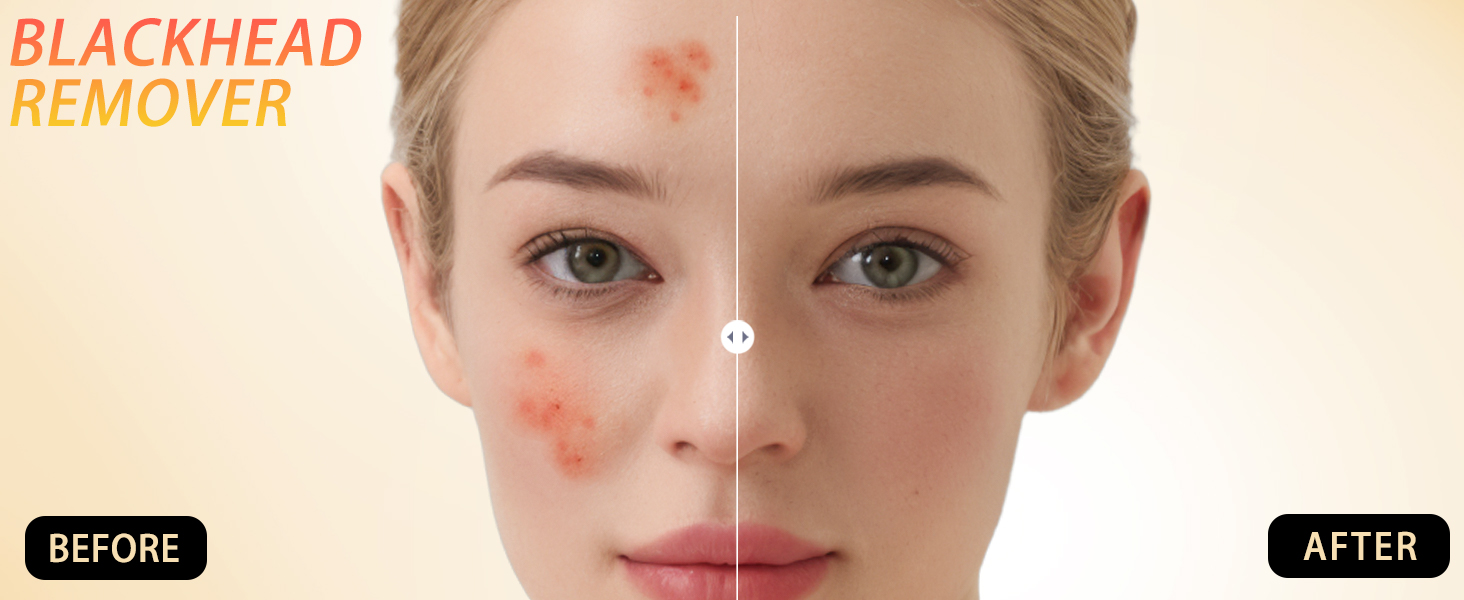 black head remover for face tool