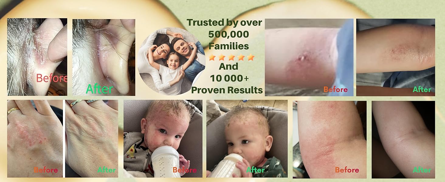Eczema Cream, rash cream, tea tree oil balm