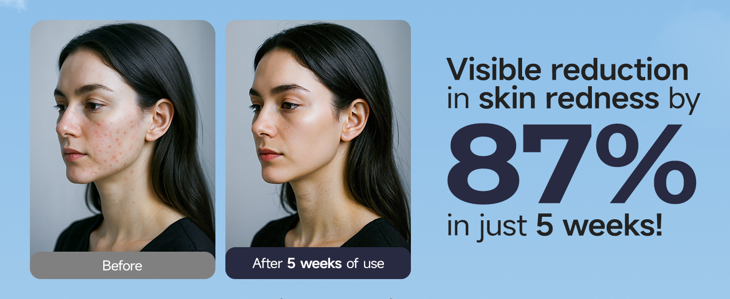 reduce redness by 87% in just 5 weeks