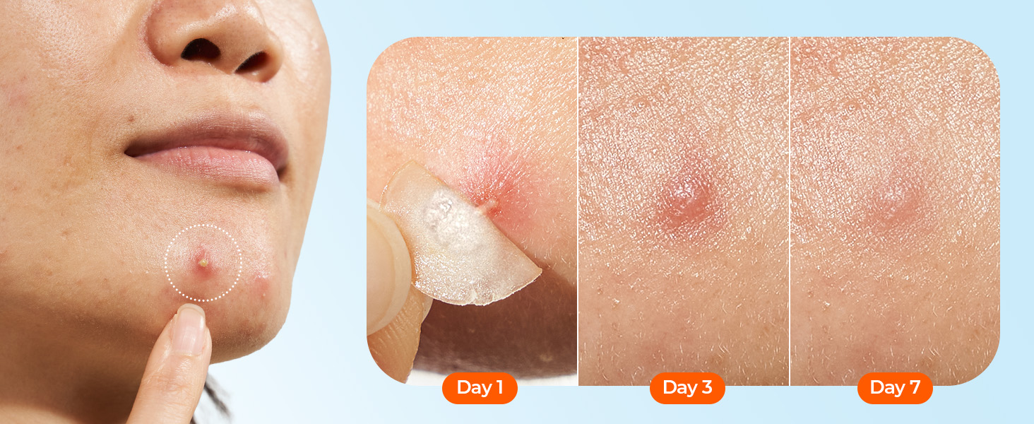 large pimple patches