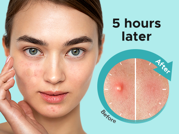 pimple patches