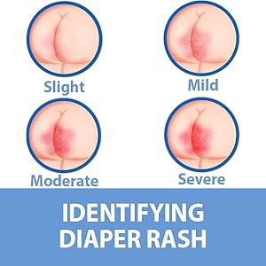Identifying diaper rash
