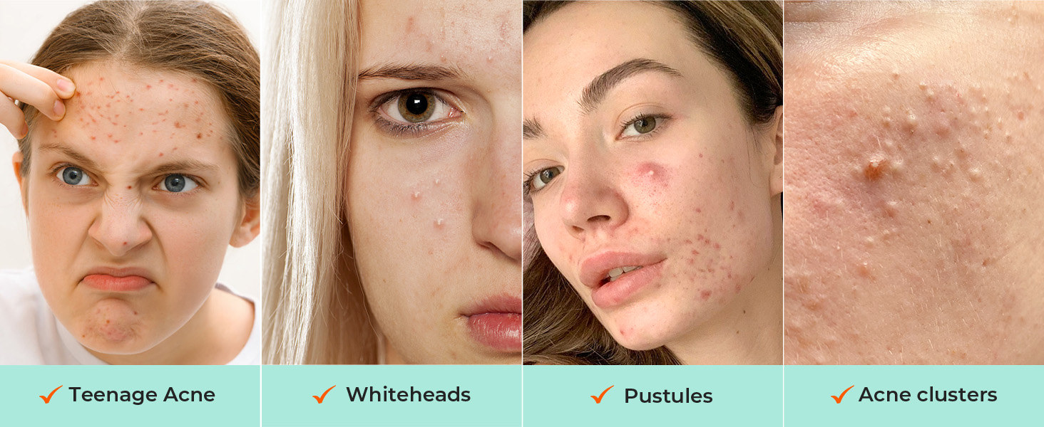 For teenage acne, whiteheads, pustules or acne clusters