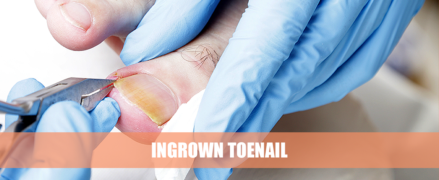 Ingrown Toenails