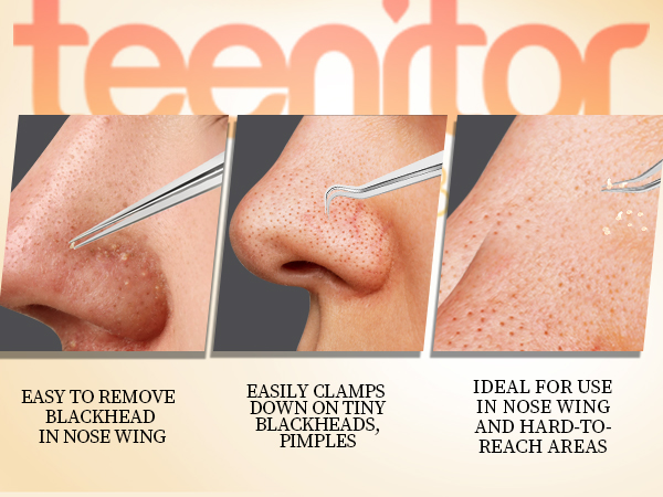 pimple tweezers