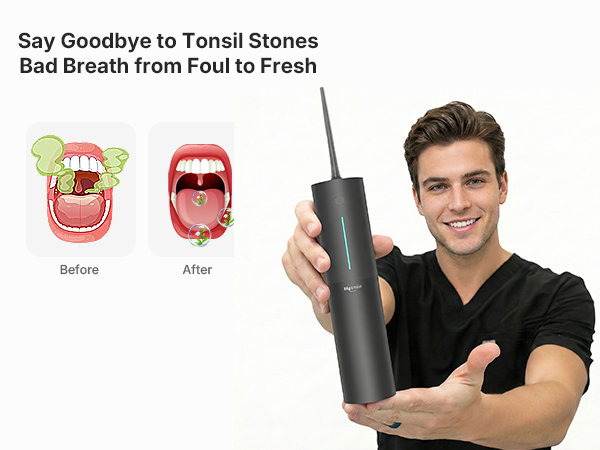 tonsil stones