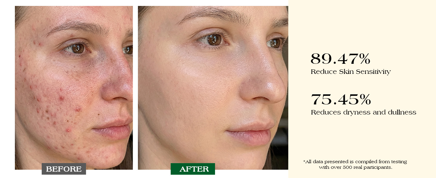89.47% Reduce Skin Sensitivity 75.45% Reduces dryness and dullness