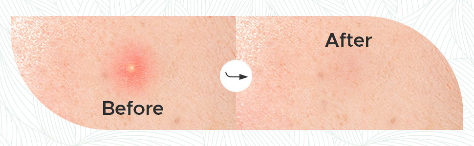 zit patch