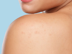 Large Pimple Patches for Face