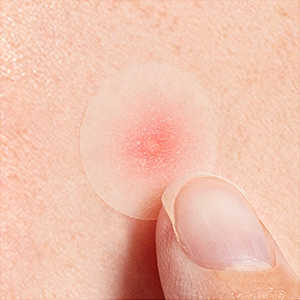acne patches for face
