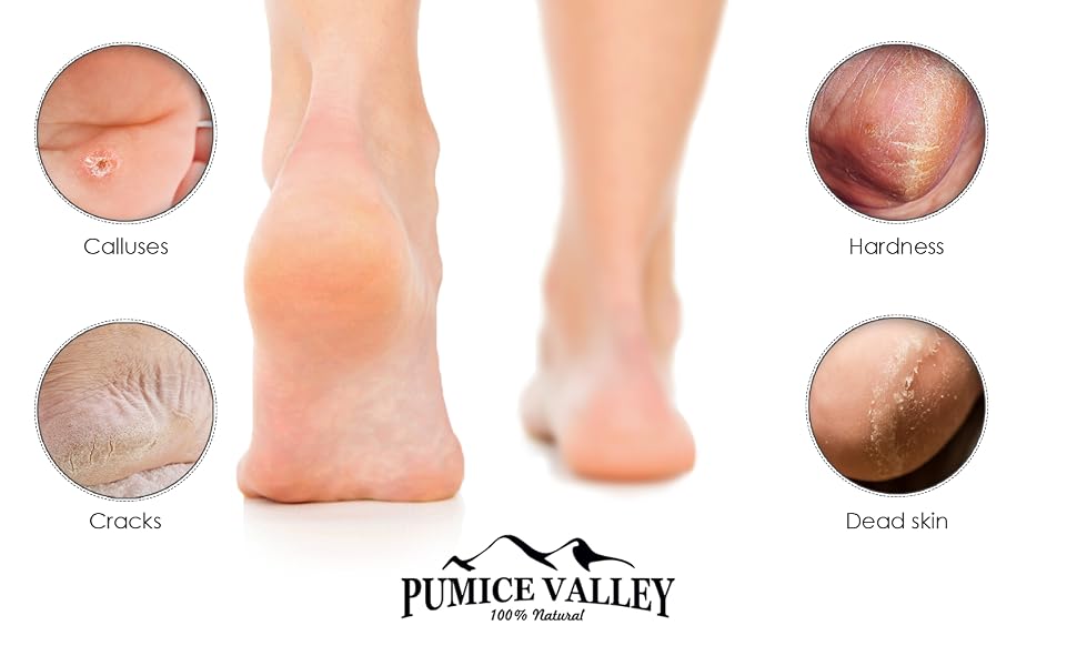 callus remover