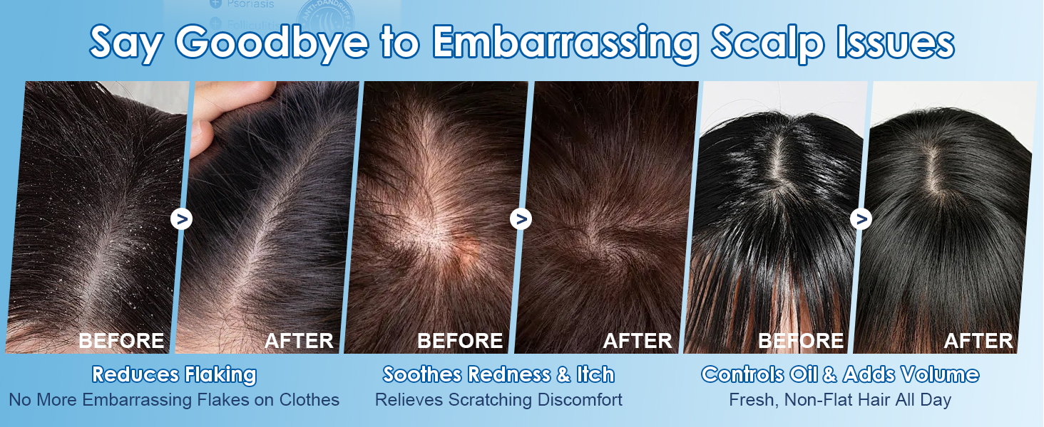 psoriasis shampoo