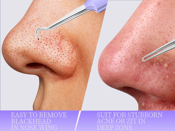 Pimple Extractor