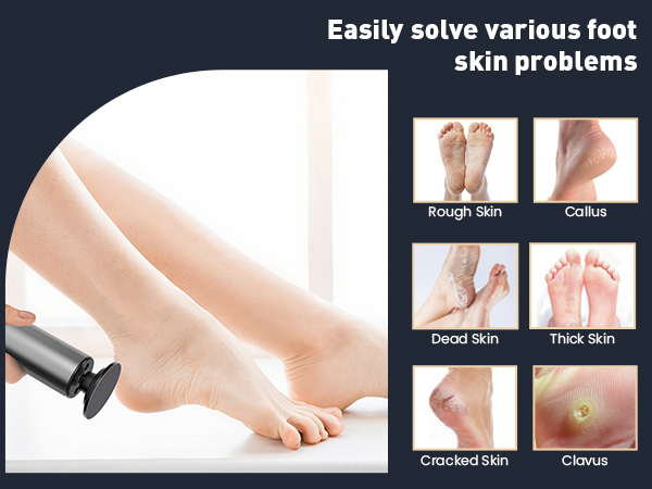 foot callus remover