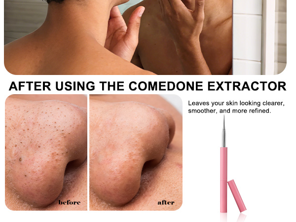 black head remover comedone extractor blackhead extraction kit pimple tool pimple remover acne