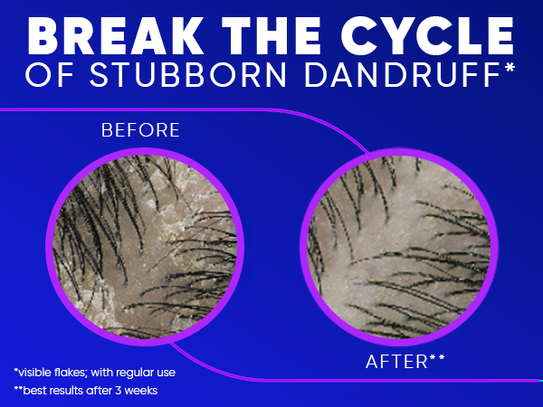End stubborn dandruff; achieve visible flakes relief with consistent usage.