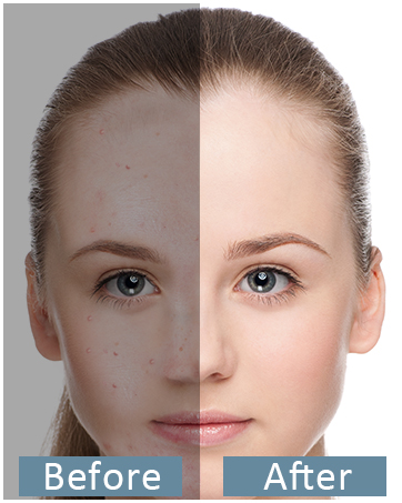 whitehead remover