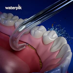 Using the Waterpik Implant Tip DT-100E on Lower Arch